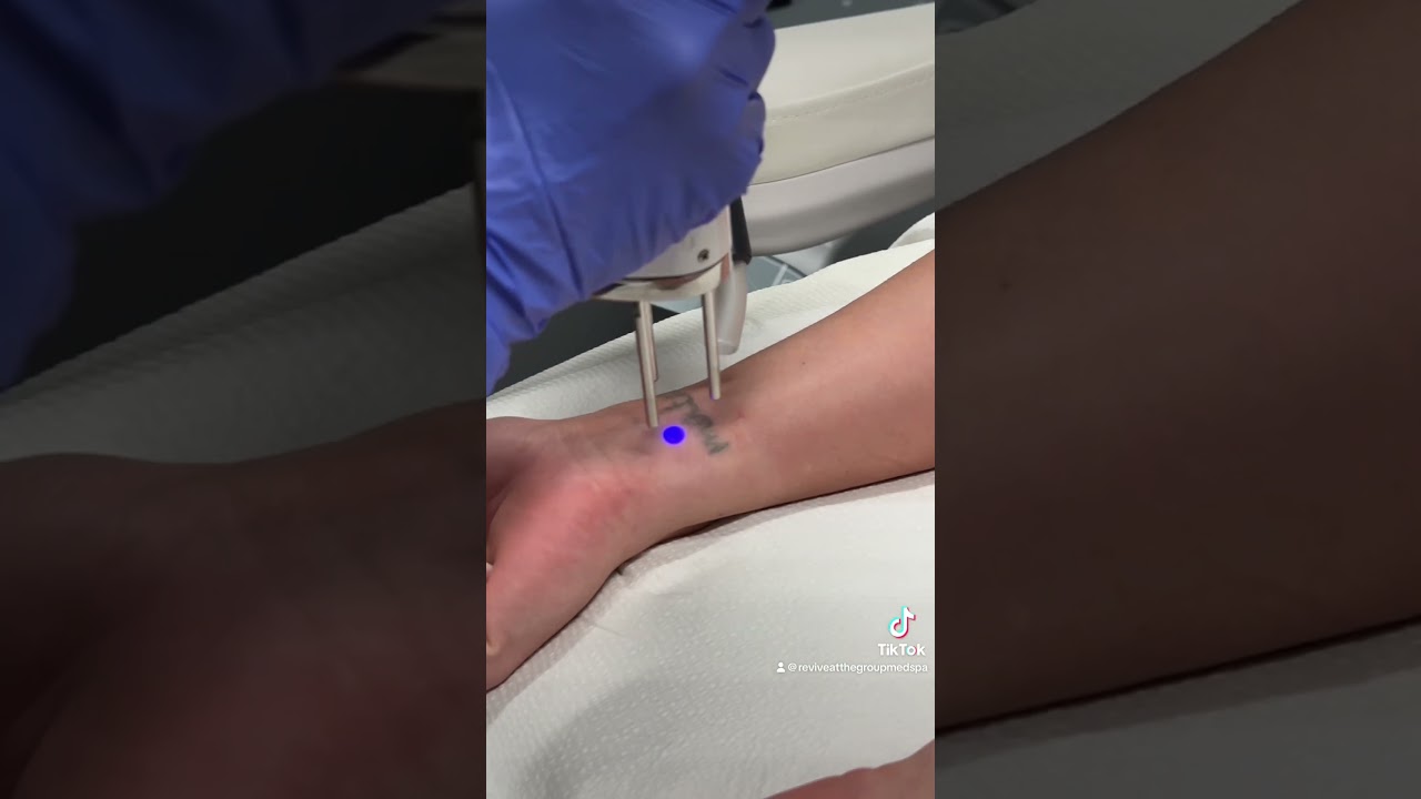 How Much Does Laser Tattoo Removal Cost?